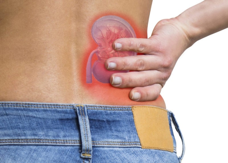 Symptoms of Kidney Stone