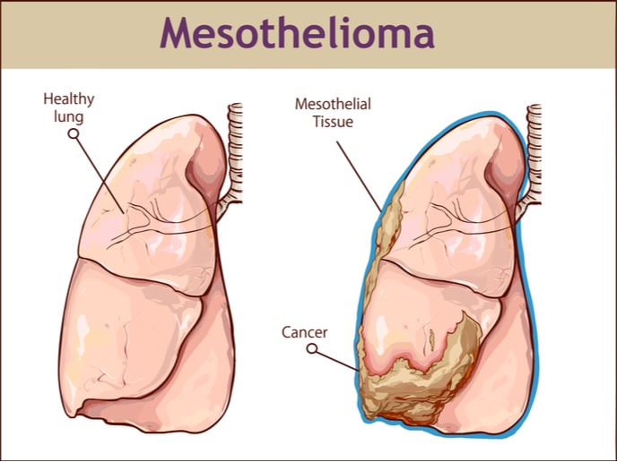 What is Mesothelioma, Major Causes, Stages, and Treatment
